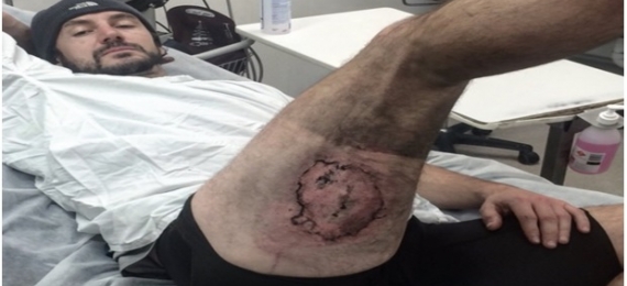 Ciclista Sofre Queimaduras após Explosão de IPhone do Bolso